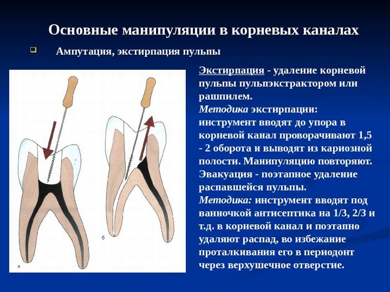 Витальная экстирпация