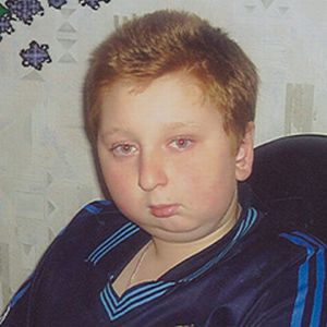 микрогения односторонняя
