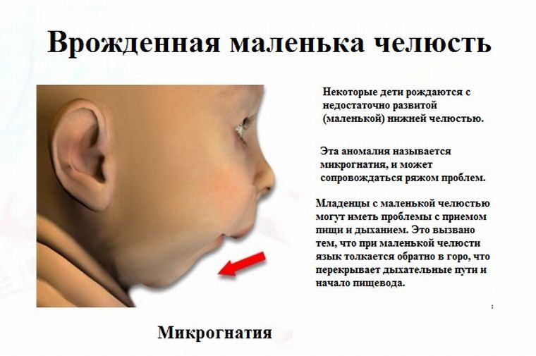 Микрогнатия