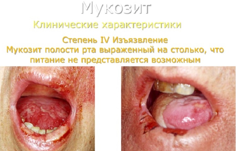 Мукозит 4 стадии