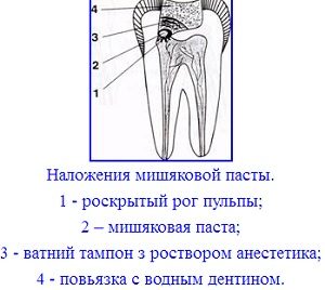 Заложение мышьяка