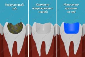 Нанесение адгезива