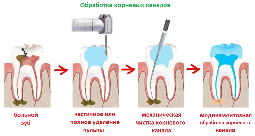 Обработка корневых каналов