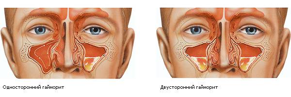 Гайморит