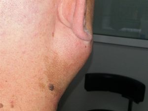 аденома околоушной слюнной железы