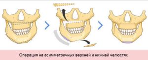 Коррекция кривой челюсти