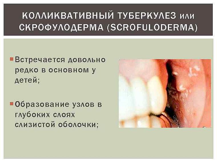 скрофулодерма