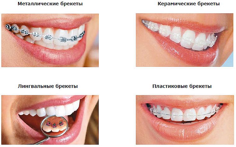 разновидности брекетов