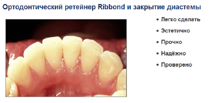 Ортодонтический ретейнер