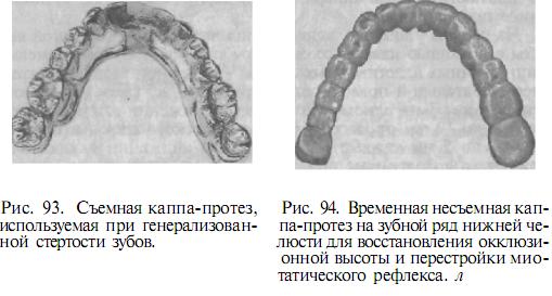 Каппа-протез для восстановления окклюзии