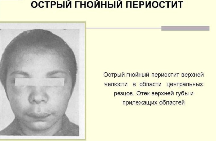 острый периостит челюсти