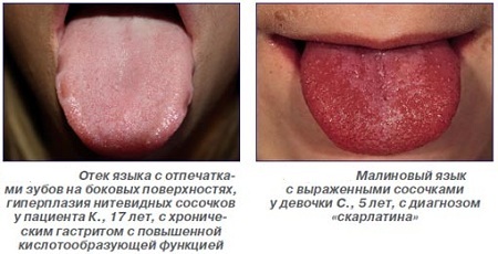 Отек и отпечатки языка