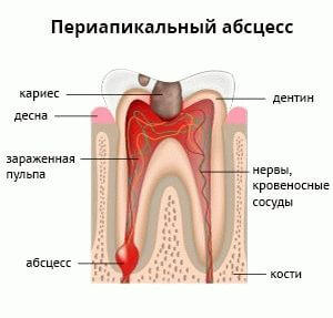 периапикальный абсцесс