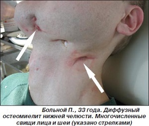 Пациент с остеомиелитом