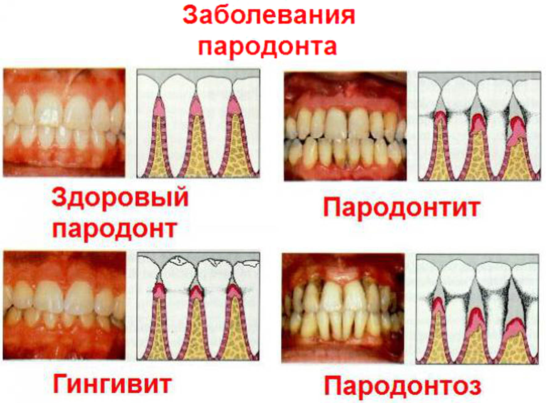 Болезни десен