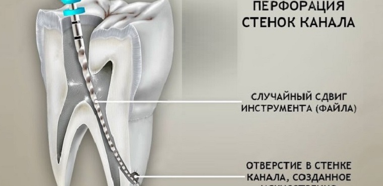 Перфорация корня зуба
