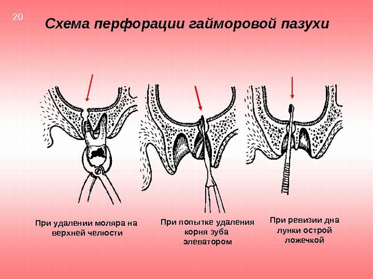 Перфорация гайморовой пазухи при удалении зуба