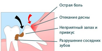 симптомы перикоронарита