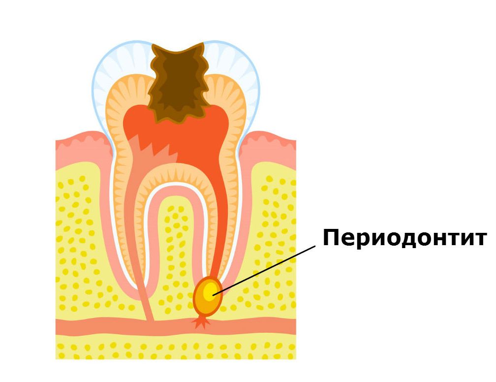 периодонтит