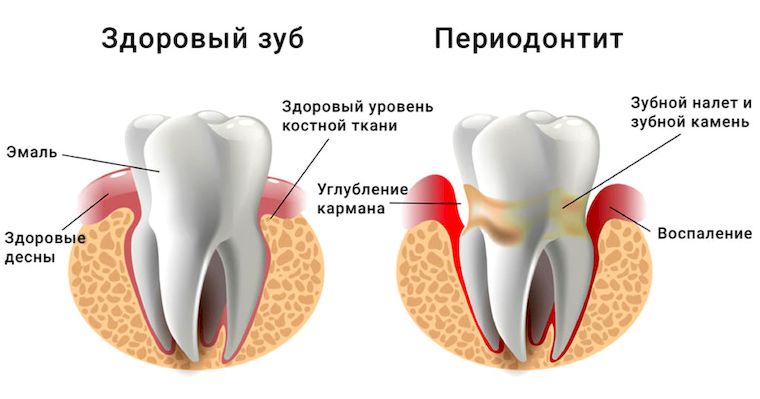 что такое периодонтит