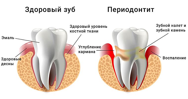периодонтит