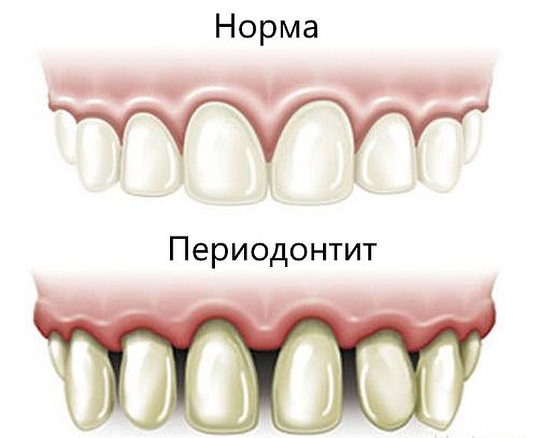 периодонтит