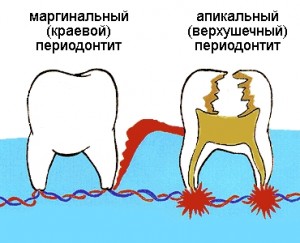 Верхушечный и маргинальный периодонтит