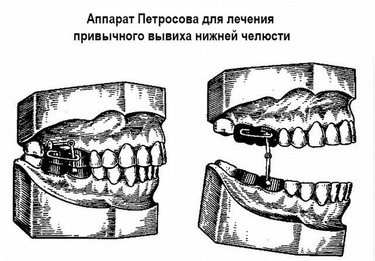 аппарат Петросова