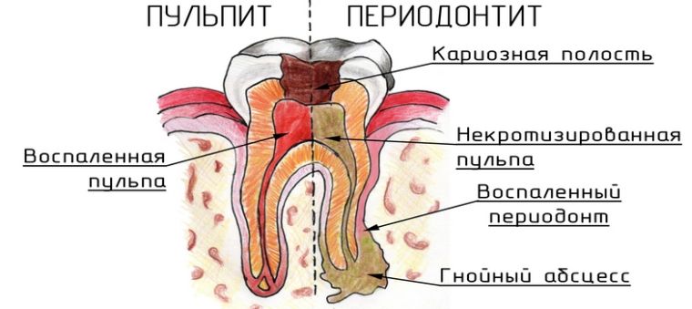 Чем пульпит отличается от периодонтита