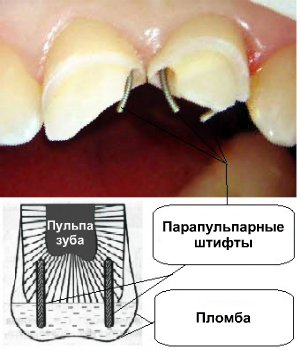 Схема установки пина