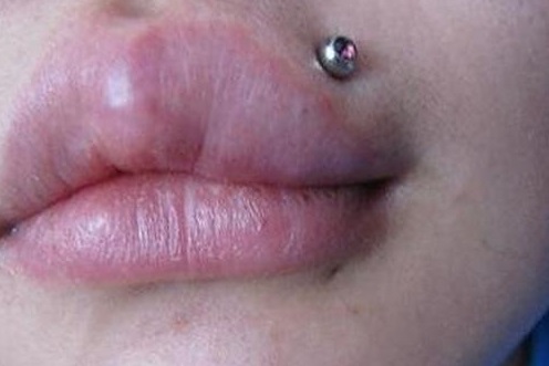 Опухла губа