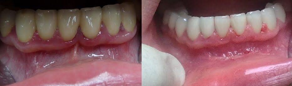 Результаты пластики