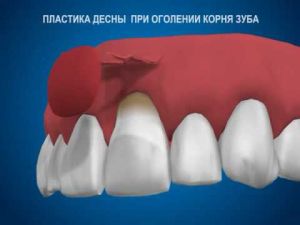 Пластика десны