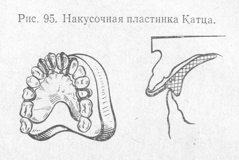 Накусочная пластинка Катца