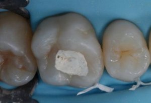 Установка пломбы