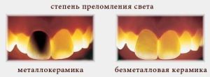 степень преломления зубов из кер
