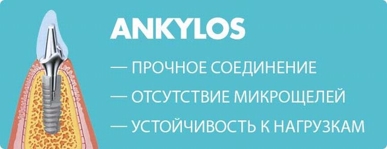Плюсы имплантов