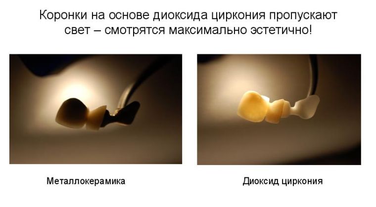 До и после протезирования