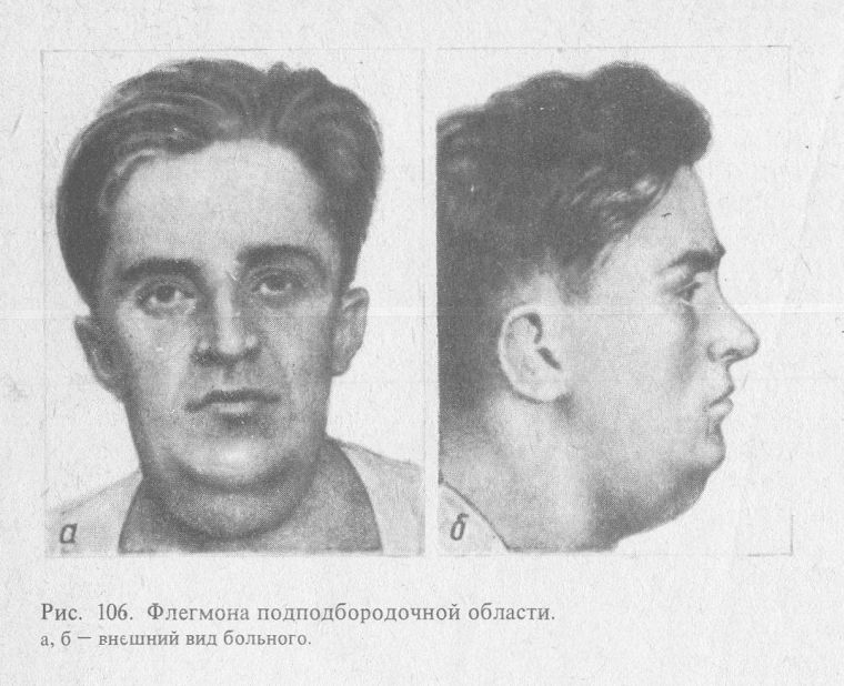 Подчелюстная флегмона