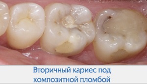 Кариес под композитной пломбой