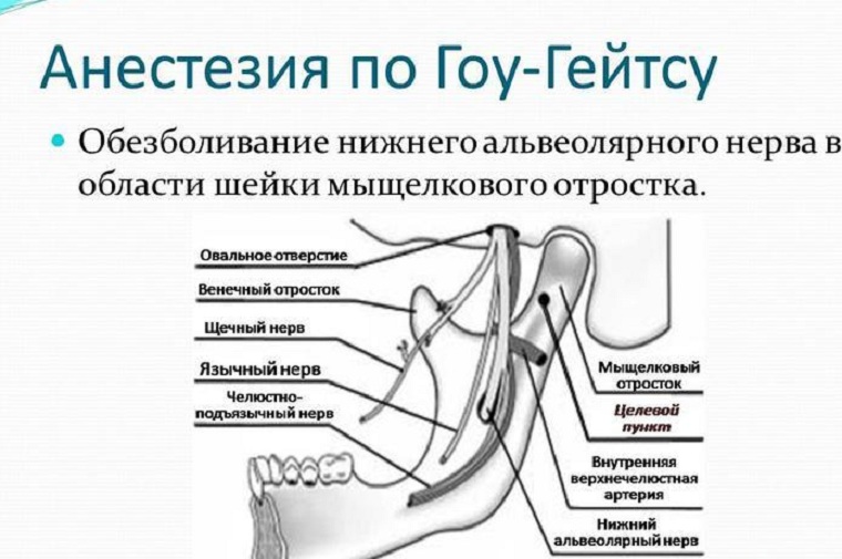 Анестезия по Гоу-Гейтсу
