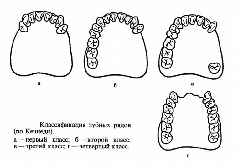 Классификация Кеннеди