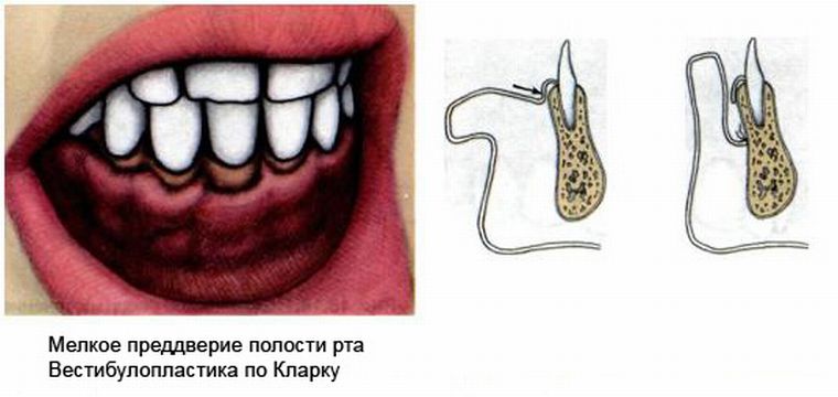 Операция по Кларку