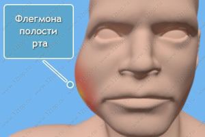 Флегмона дна полости рта