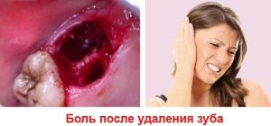 боль после удаления зуба