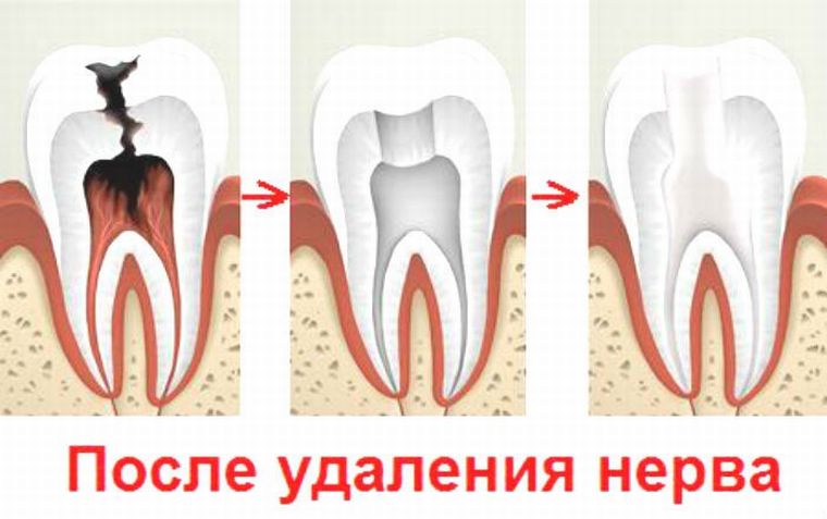 После удаления нерва зубного