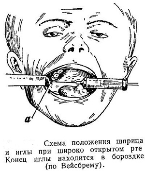 Место укола