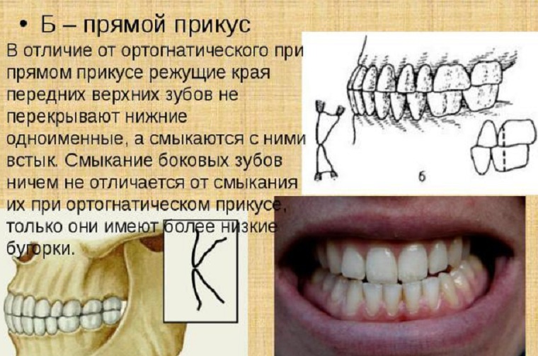 Что такое прямой прикус