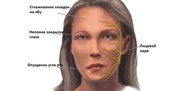 невралгия тройничного нерва