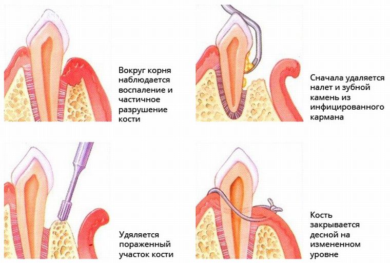 Открытый кюретаж